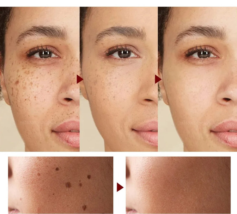 Beauty Mole Removal Pen